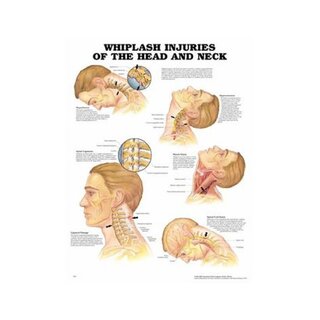 Pisksnärtsskada laminerad affisch engelsk (Whiplash injuries)