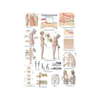 Plansch Osteoporos, Anatomisk Affisch 50x70cm