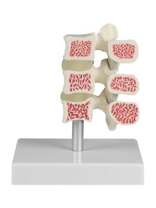 Osteoporos kotor modell, 3 kotor
